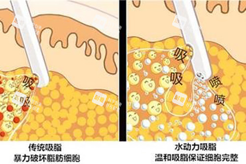吸脂示意图 吸脂示意图