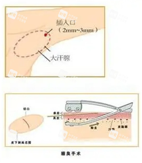 腋臭手术过程图解 腋臭手术过程图解