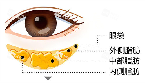 眼袋问题形成因 眼袋问题形成因
