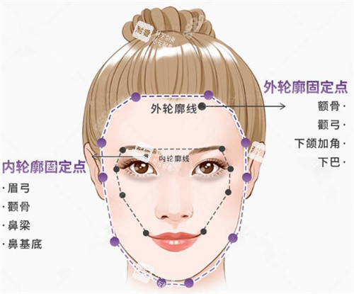 轮廓固定图示