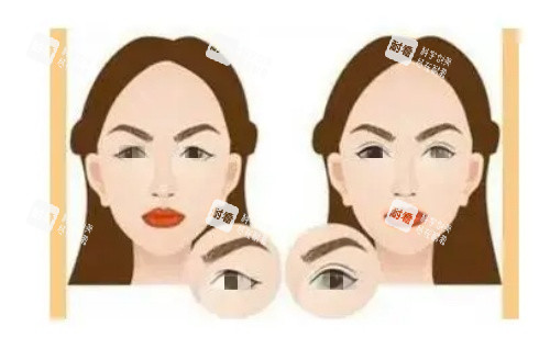 双眼皮术前术后对比图 双眼皮术前术后对比图