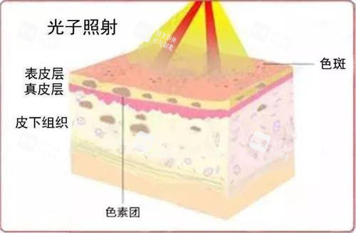 光子嫩肤的示意图.