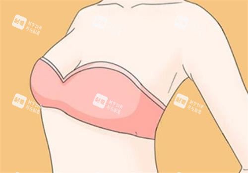 隆胸术后成效图 隆胸术后成效图