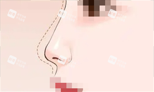隆鼻预期弧度动画呈现图 隆鼻预期弧度动画呈现图
