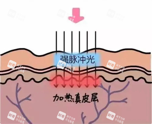 光子嫩肤针对的皮肤层 光子嫩肤针对的皮肤层