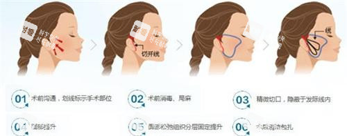 微拉美拉皮手术过程图 微拉美拉皮手术过程图
