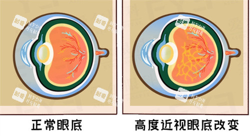 眼底视力呈现 眼底视力呈现