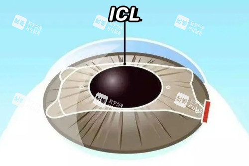 ICL晶体植入卡通一览图 ICL晶体植入卡通一览图