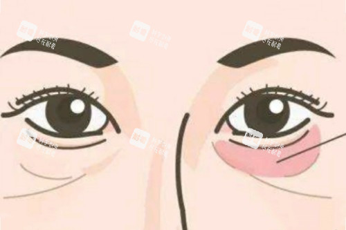 眼袋卡通图