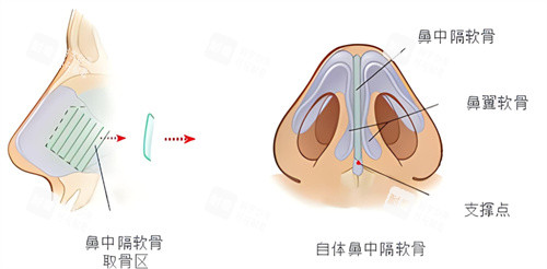 隆鼻鼻中隔软骨鼻 隆鼻鼻中隔软骨鼻