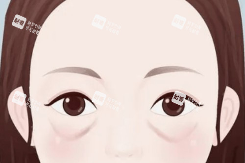眼袋卡通展示图 眼袋卡通展示图
