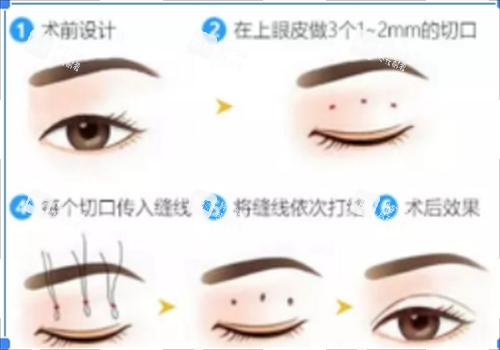 埋线双眼皮流程图 埋线双眼皮流程图