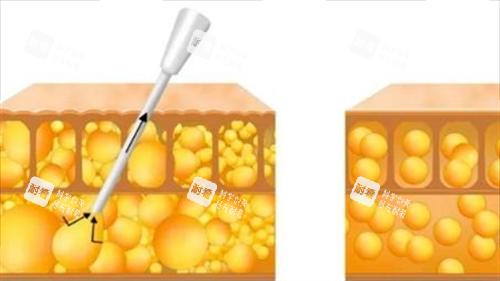 吸脂过程动画脂肪前后变化 吸脂过程动画脂肪前后变化
