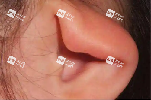 重度杯状耳.webp