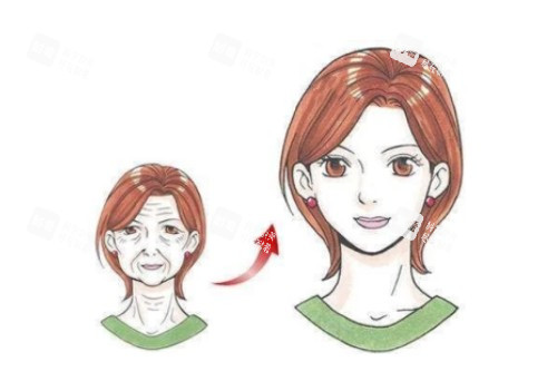面部拉皮提升卡通对比图 面部拉皮提升卡通对比图