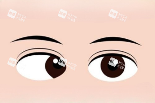 眼睛斜视卡通图