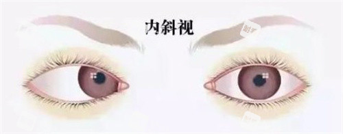 斜视 斜视