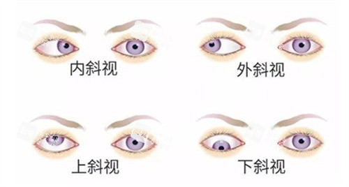 内外斜视、上下斜视 内外斜视、上下斜视