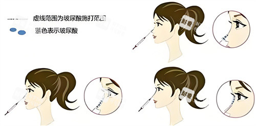 隆鼻玻尿酸部位图 隆鼻玻尿酸部位图