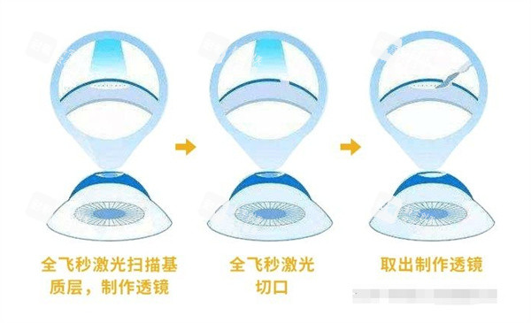 全飞秒激光治眼睛切口