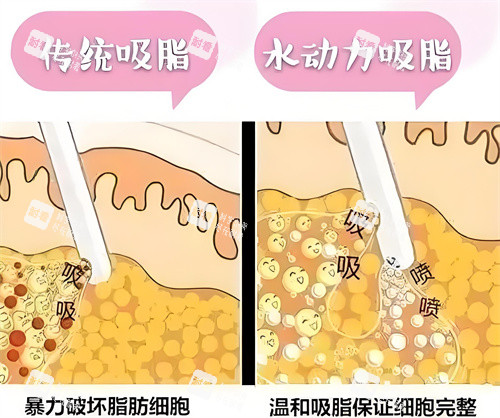 负压吸脂和水动力吸脂方式对比动画图 负压吸脂和水动力吸脂方式对比动画图