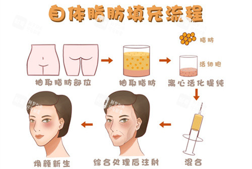自体脂肪移植填充额头动画演示图 自体脂肪移植填充额头动画演示图