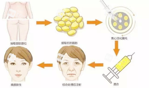 自体脂肪面部填充 自体脂肪面部填充