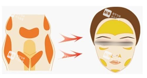 自体脂肪面部填充示意图 自体脂肪面部填充示意图