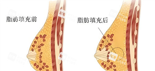 自体脂肪隆胸脂肪对比 自体脂肪隆胸脂肪对比