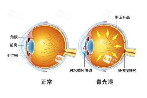 正常眼睛与青光眼概念对比图