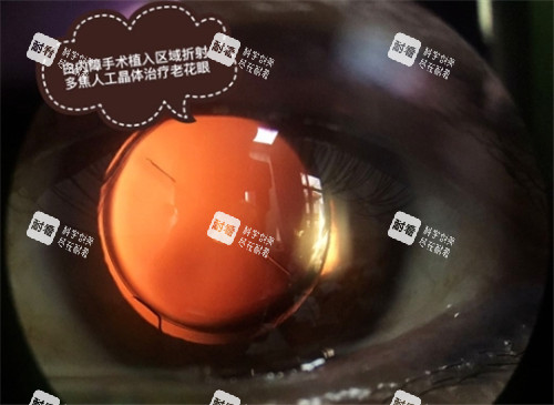 白内障手术细节图 (2)