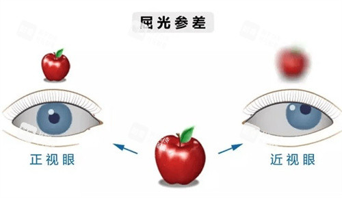 屈光参差 屈光参差