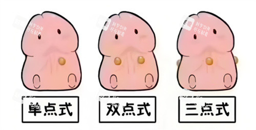 入珠手术动画 入珠手术动画