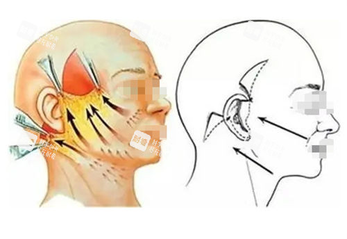 拉皮手术前后提拉对比图