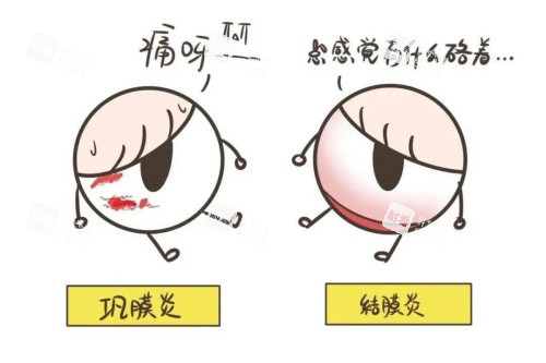 巩膜炎与结膜炎卡通对比图 巩膜炎与结膜炎卡通对比图