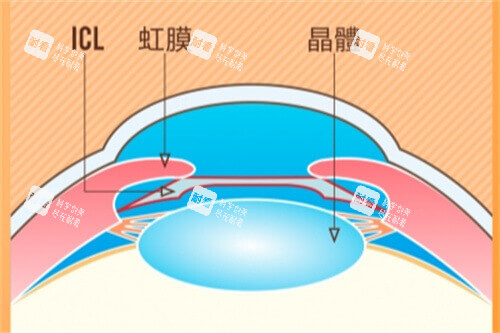 ICL示意图 ICL示意图