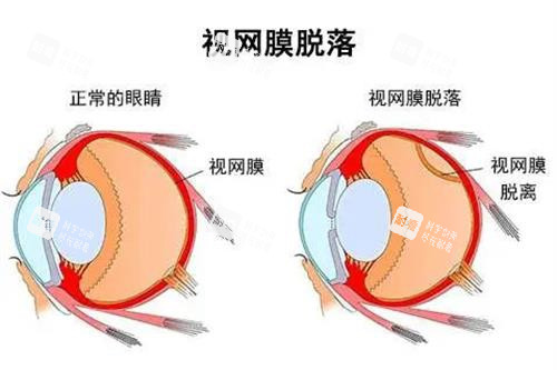视网膜脱落和正常眼示意图 视网膜脱落和正常眼示意图