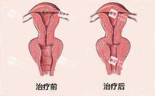 女性阴道紧缩手术前后对比动画图 女性阴道紧缩手术前后对比动画图