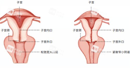 阴道紧缩术施术位置图解 阴道紧缩术施术位置图解