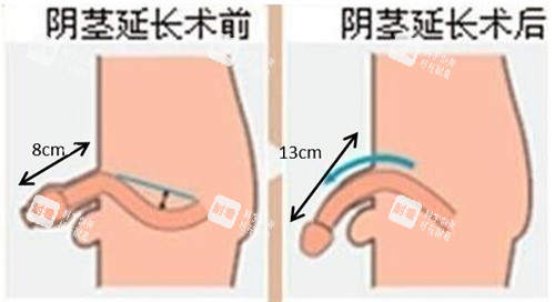 阴茎增长手术前后对比动画图