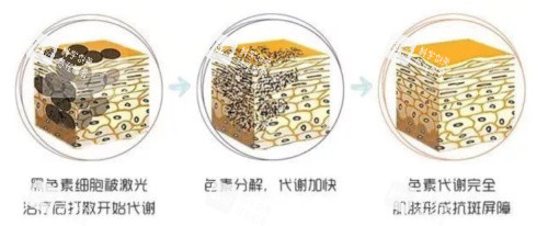 激光祛斑的原理 激光祛斑的原理