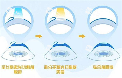 飞秒激光手术过程 飞秒激光手术过程