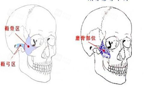 颧骨磨骨手术示意图 颧骨磨骨手术示意图