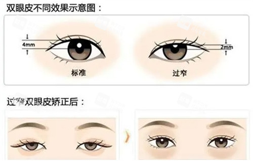 不同高度的双眼皮 不同高度的双眼皮