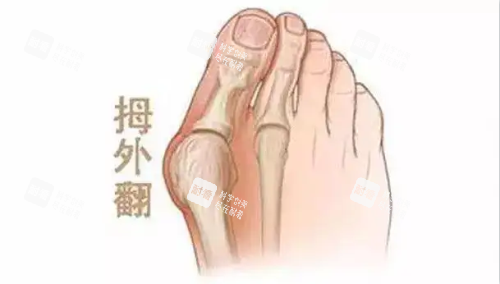 大脚骨示意图 大脚骨示意图