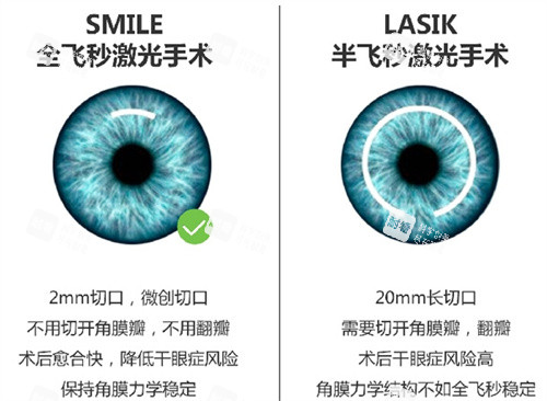 全飞秒与半飞秒手术对比图