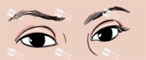 双眼皮肉条感