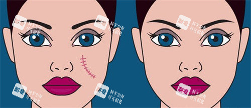 疤痕消除对比 疤痕消除对比