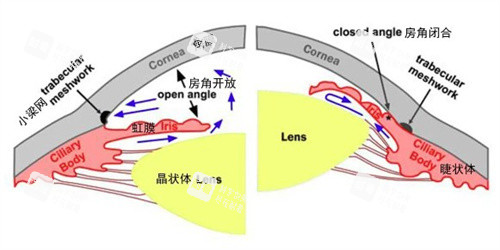 青光眼和正常眼睛的对比