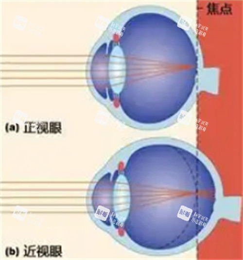 正常眼睛和近视眼镜的不同